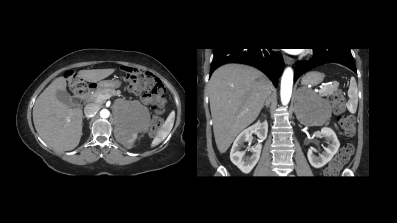 Adrenal-ACC-Ki67-Seg: Adrenocortical Carcinoma