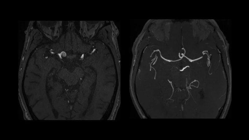 MRA Intracranial Aneurysms (Lausanne Cohort)