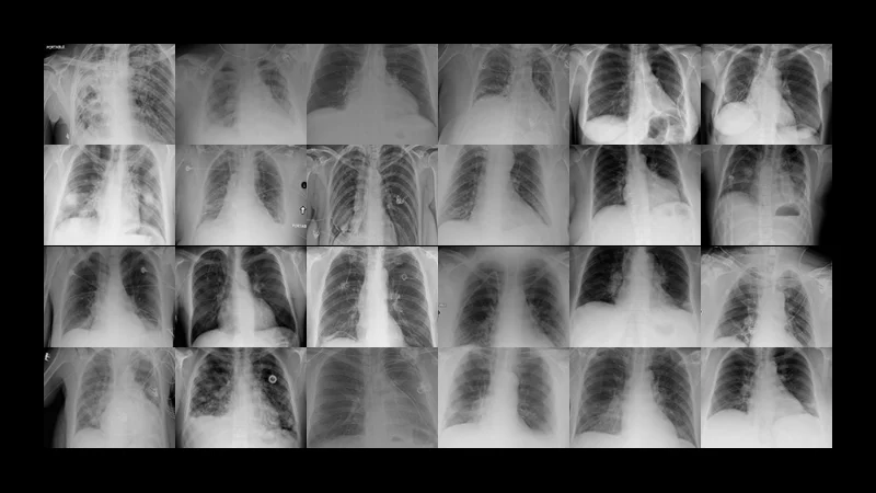 NIH Chest Xray Dataset