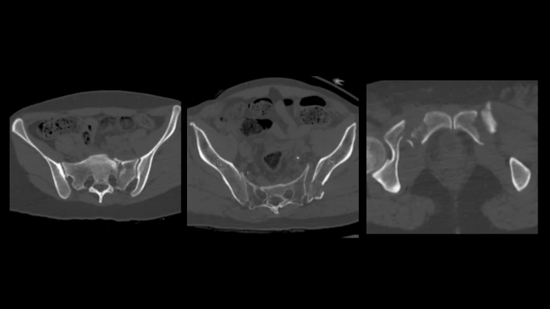 Pelvic Fractures (PENGWIN task 1)